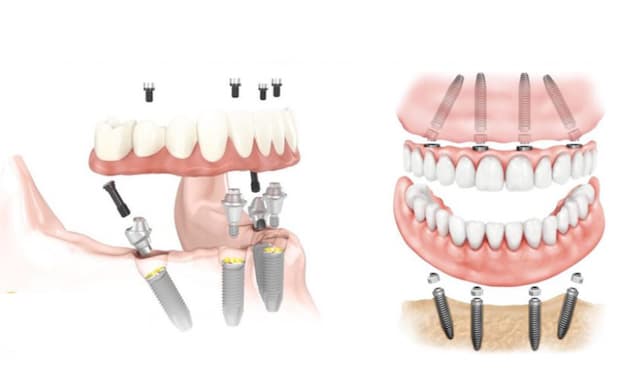 Implant là phương pháp dành cho những người bị mất răng toàn hàm nhưng không muốn đeo hàm giả tháo lắp.