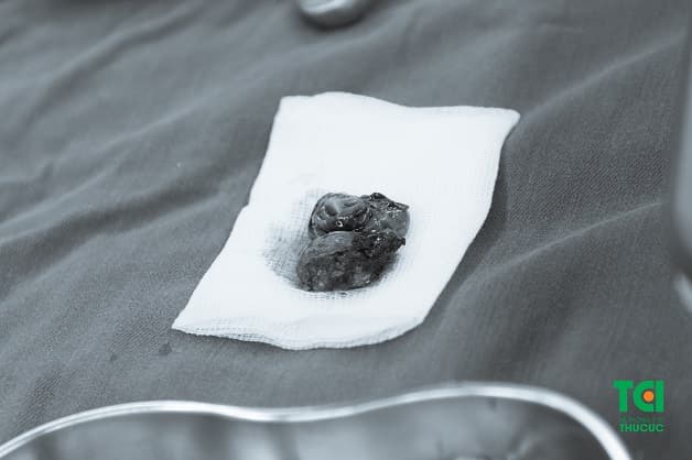 Hình ảnh amidan bị cắt bỏ thông qua phẫu thuật