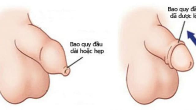 Dài bao quy đầu có ảnh hưởng gì không?