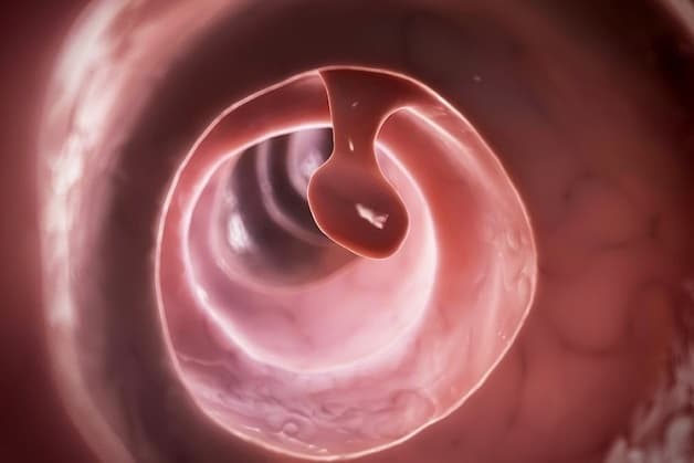 Nguyên nhân chính dẫn đến polyp đại tràng sigma