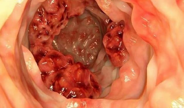 dấu hiệu ung thư đại tràng giai đoạn cuối
