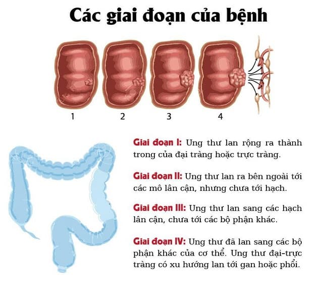 dấu hiệu ung thư đại tràng giai đoạn đầu