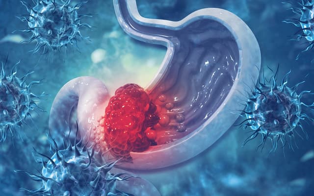 Điều trị ung thư dạ dày ở đâu tốt nhất? Phương pháp điều trị