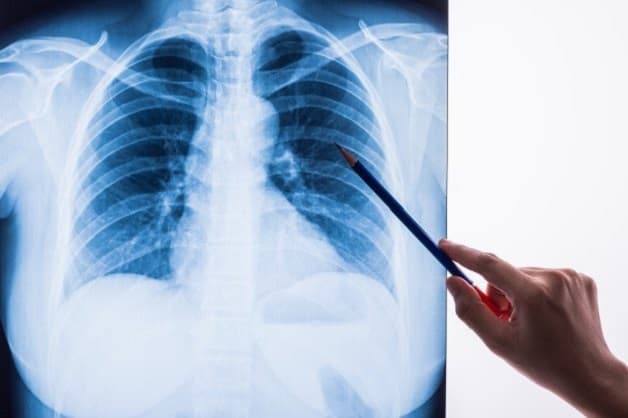 Điều trị ung thư phổi ở đâu tốt nhất tại Hà Nội