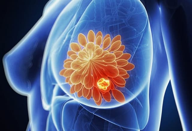 Điều trị ung thư vú tốn bao nhiêu tiền, làm sao để tiết kiệm?