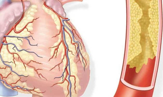 Bệnh mạch vành là tình trạng mạch vành bị tắc hẹp do sự lắng đọng cholesterol và các chất khác.