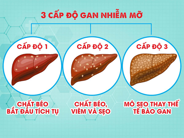 Gan nhiễm mỡ độ 1 là giai đoạn nhẹ nhất của bệnh
