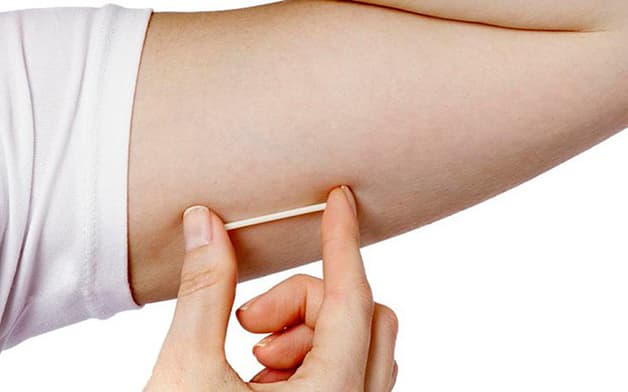 Giá cấy que tránh thai Implanon khoảng 3.000.000 đồng