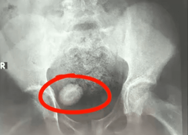 Hình ảnh sỏi bàng quang rõ nét qua chụp X - quang