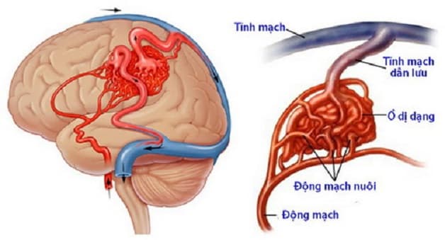 Dị dạng mạch máu não là một trong những nguyên nhân gây đau nửa đầu đau tai.