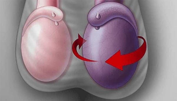 Teo hoặc co rút tinh hoàn là một trong những dấu hiệu phổ biến của giãn tĩnh mạch thừng tinh