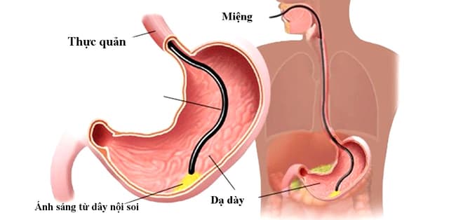 Khám nội soi dạ dày bao nhiêu tiền? Những lưu ý cần biết