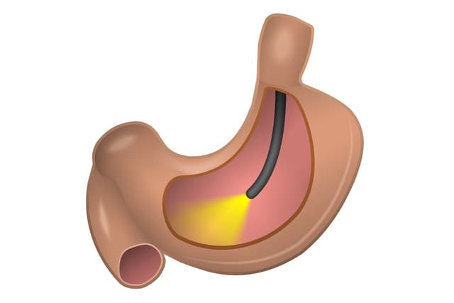 Nội soi dạ dày để làm gì? Các phương pháp nội soi