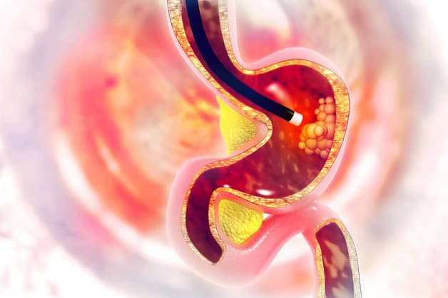 Nội soi tiêu hóa ở đâu tốt