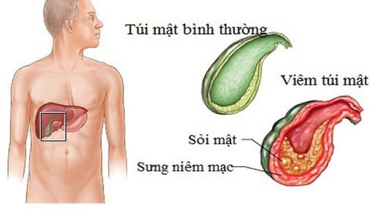 Phác đồ điều trị viêm túi mật hiệu quả nhất