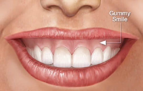 Mô phỏng tình trạng cười hở lợi