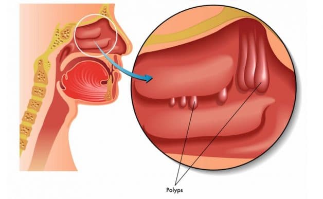 Polyp mũi chặn hoặc làm hạn chế luồng không khí và dịch nhầy bên trong xoang