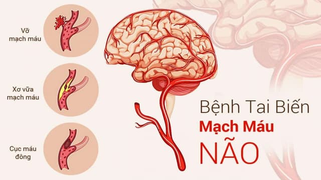 Triệu chứng tai biến mạch máu não và cách phòng bệnh