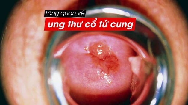 Ung thư cổ tử cung là căn bệnh nguy hiểm thường mắc ở phụ nữ trên 35 tuổi.