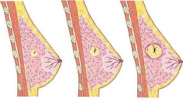 U nang tuyến vú là những túi nhỏ hình thành ở bên trong mô tuyến vú và thường được phát hiện ở nửa trên của vú.