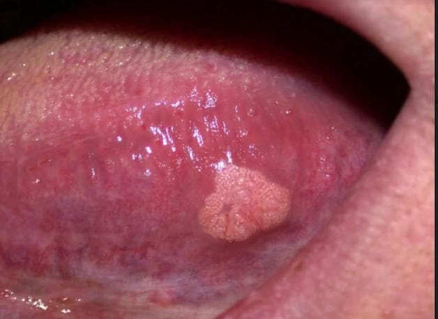 U nhú lưỡi là tình trạng các nhú lưỡi hay chồi vị giác sẽ sưng lên, gây khó chịu và đau đớn.