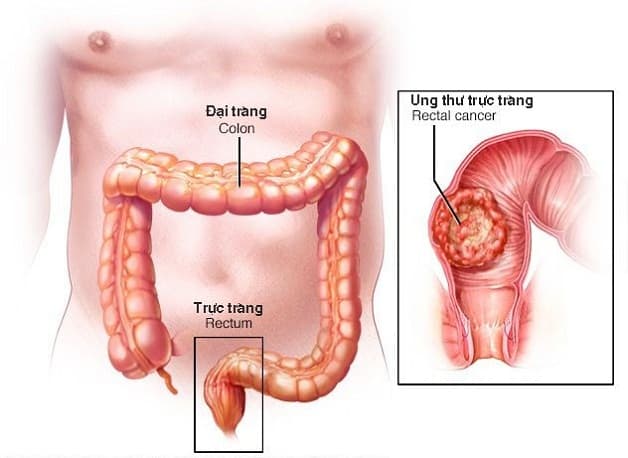 U trực tràng ác tính là bệnh lý nguy hiểm có thể đe dọa đến tính mạng người bệnh