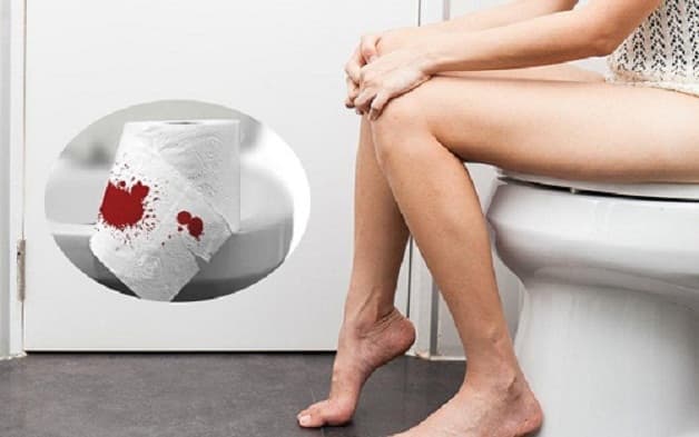 Đi ngoài ra máu là một dấu hiệu nhận biết u trực tràng ác tính