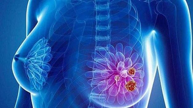 Ung thư vú là bệnh do tế bào tuyến vú phát triển không kiểm soát được, tạo ra các khối u ác tính.