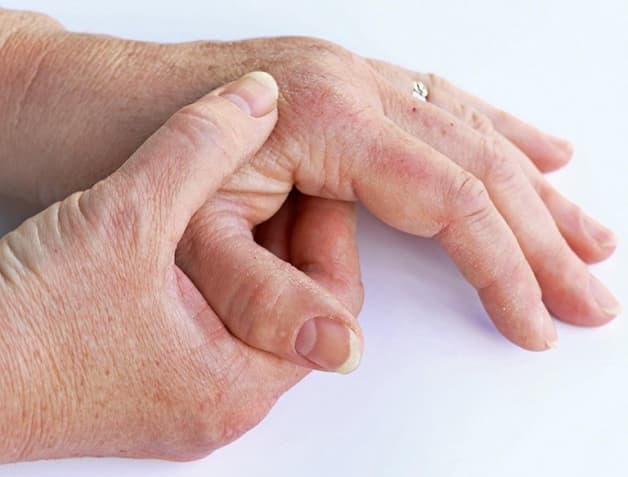 đau khớp ngón tay