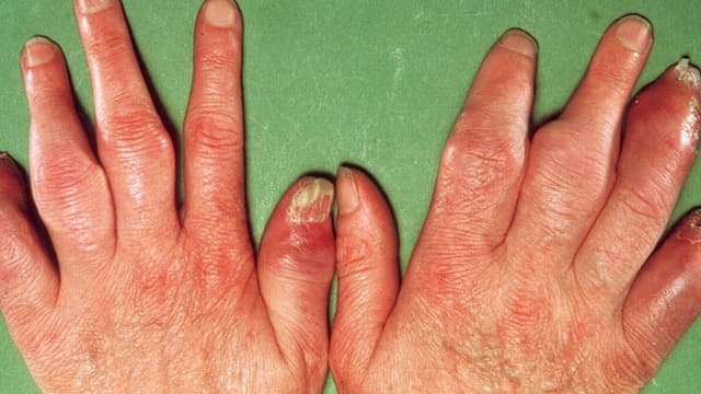 Viêm khớp vảy nến với 9 triệu chứng thường gặp nhất