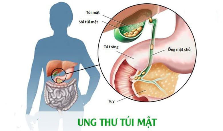 Viêm túi mật có nguy hiểm không - có nguy hiểm