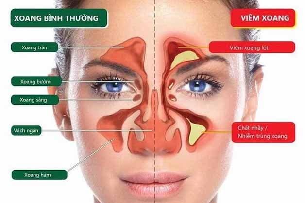 Viêm xoang mũi là khi các hốc xoang này bị nhiễm trùng, dịch nhầy hô hấp không lưu thông được, gây bít tắc.