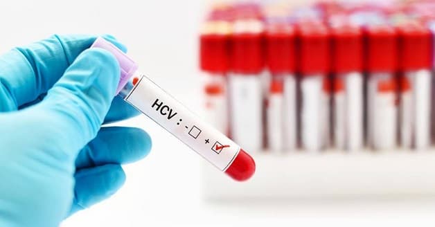 xét nghiệm viêm gan C bao nhiêu tiền phụ thuộc yếu tố nào