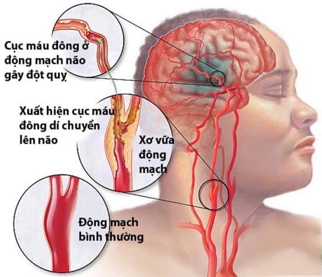 Xơ vữa động mạch cảnh là hiện tượng dày lên và xơ cứng của động mạch cảnh do sự lắng đọng cholesterol, canxi và các chất khác.