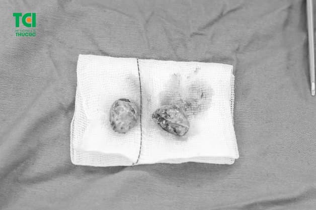 Viêm amidan hốc mủ