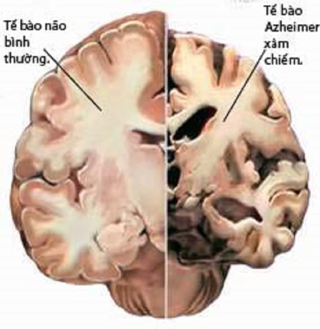 Bệnh alzheimer biểu hiện thế nào