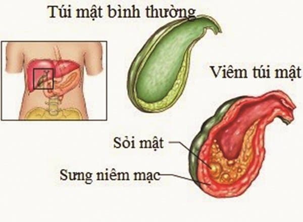 Điều trị sỏi mật hiệu quả