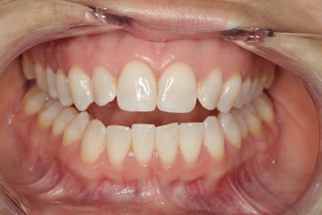 Khớp cắn hở khiến cho người bệnh không thể chạm hai hàm với nhau