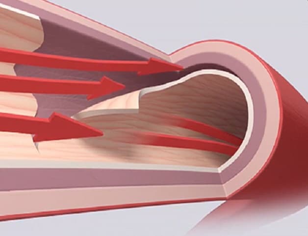 Bóc tách động mạch vành là bệnh lý mạch vành hiểm gặp nhưng nguy hiểm. 