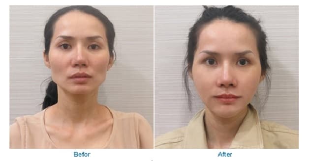 Niềng răng bị hóp má là tình trạng thường gặp khi niềng răng