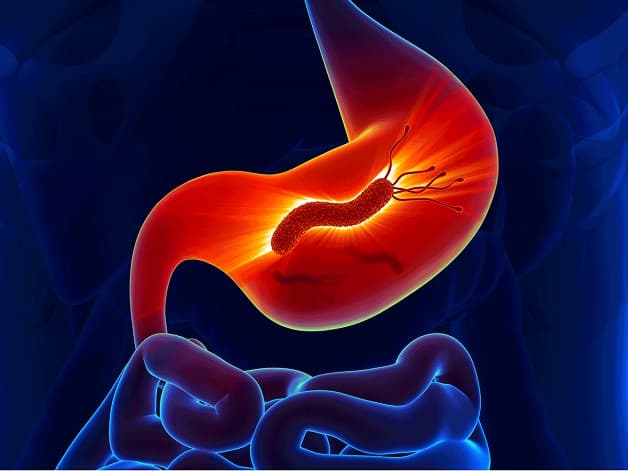 Vi khuẩn HP bao tử là một trong những nguyên nhân chính gây các bệnh lý dạ dày như viêm, loét, ung thư