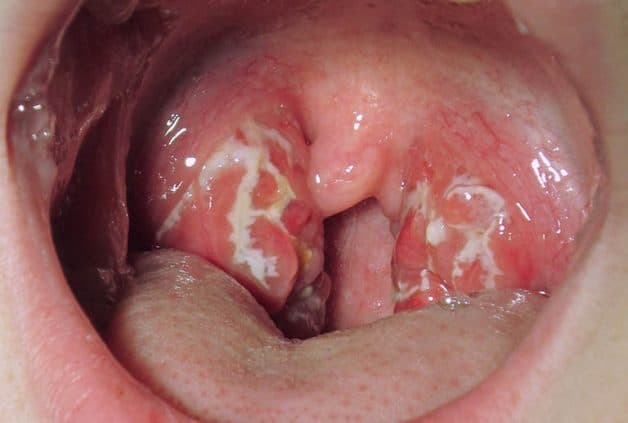 Viêm Amidan quá phát