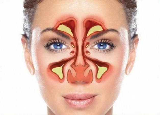 viêm xoang dị ứng