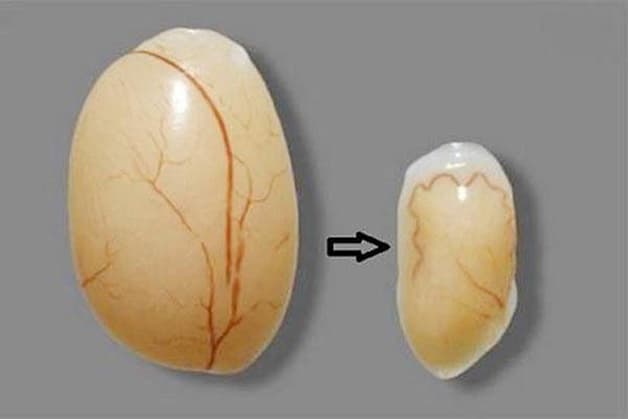 Dấu hiệu teo tinh hoàn