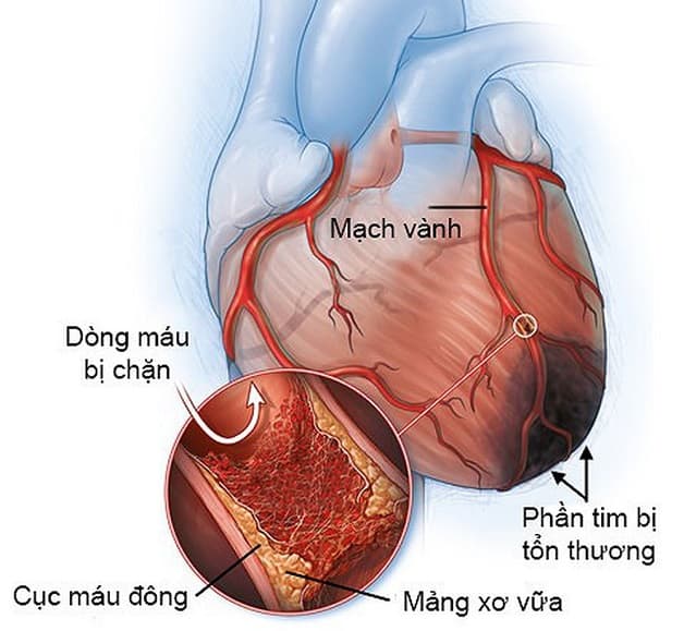 Bệnh mạch vành có thể gây ra những triệu chứng khó chịu hoặc gây nguy hiểm tới tính mạng người bệnh.