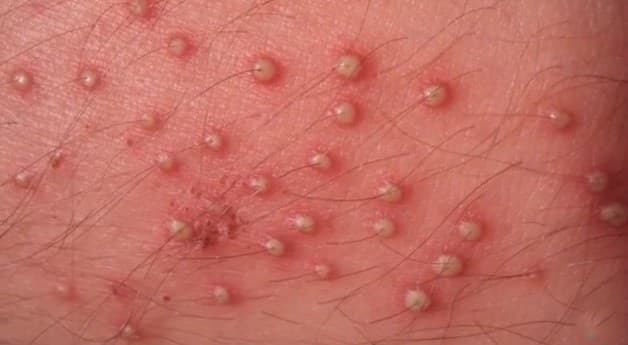 Ngứa vùng háng ở nam là hiện tượng háng bị đỏ rát, hoặc xuất hiện vết sần và các nốt mụn nước.