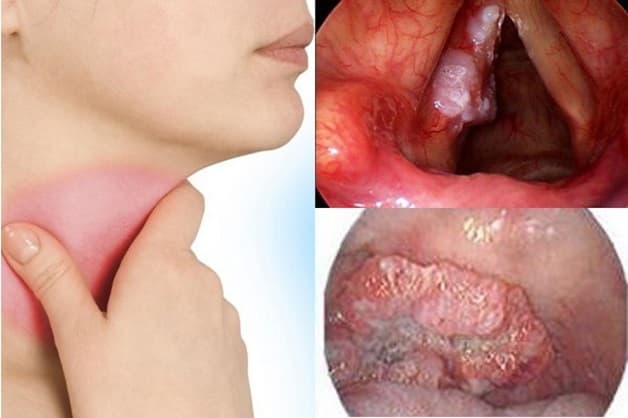 Đau cổ, khàn giọng, mất giọng là những biểu hiện ung thư thanh quản xuất hiện sớm