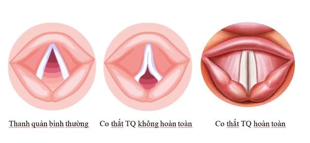 Hiểu đúng về co thắt dây thanh