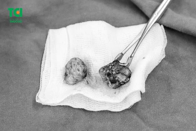 Hình ảnh amidan bị quá phát được cắt bỏ của một bệnh nhân tại BV ĐKQT Thu Cúc