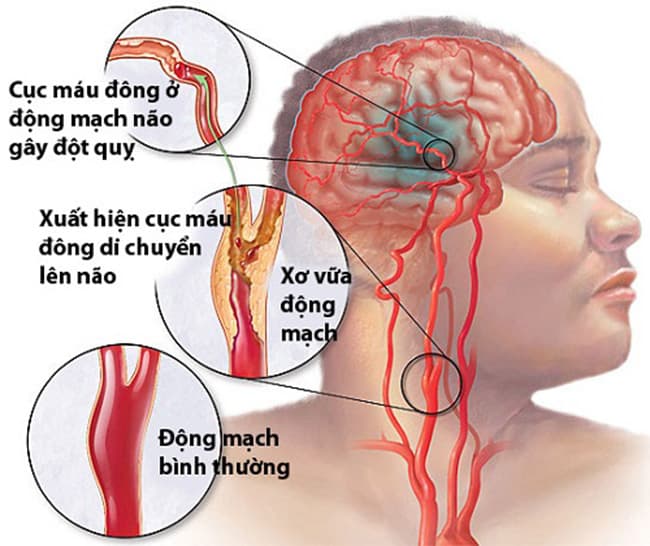 Chụp MRI mạch máu não giúp chẩn đoán sớm nhiều bệnh lý